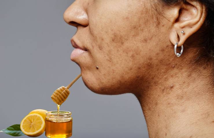 Donna con macchie sul viso e ingredienti per la maschera miele e limone 